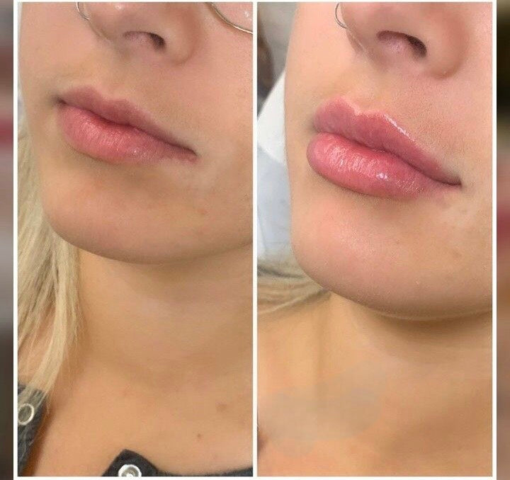 The Diamond - Lip Injections | Intense Plumper