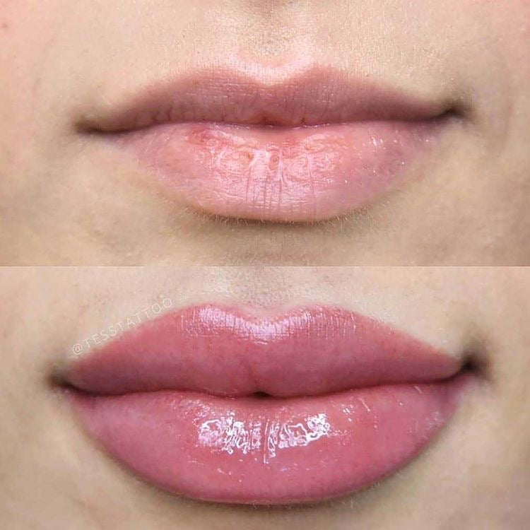 The Diamond - Lip Injections | Intense Plumper