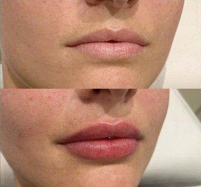 The Diamond - Lip Injections | Intense Plumper