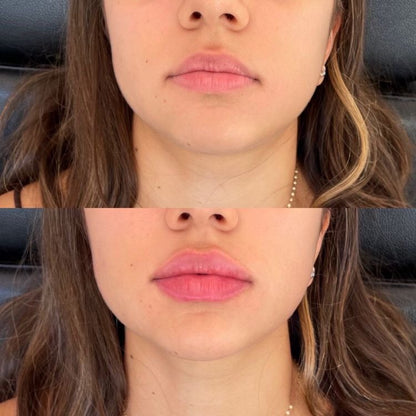 The Diamond - Lip Injections | Intense Plumper